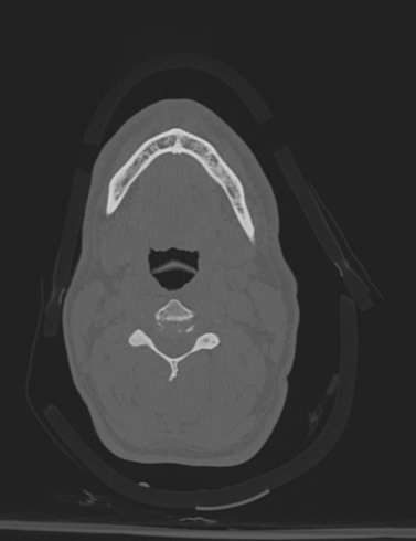 Bilateral perched facet joint (Radiopaedia 63149-71669 Axial bone window 23).jpg