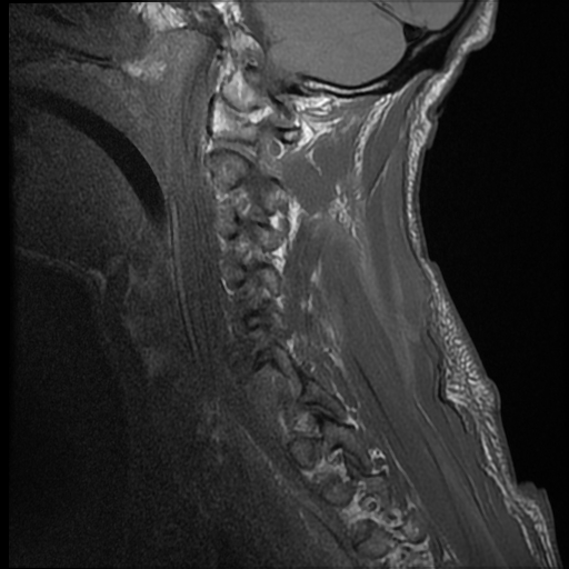 File:Bilateral perched facets with cord injury (Radiopaedia 45587-49714 Sagittal T1 13).jpg
