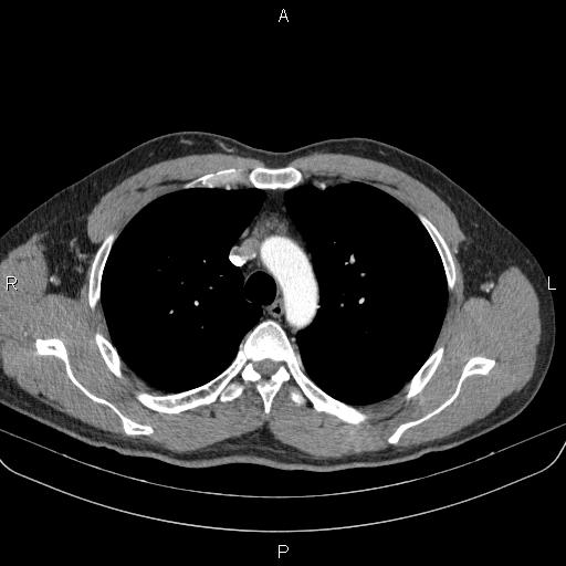 Bilateral pulmonary AVM (Radiopaedia 83134-97505 A 22).jpg