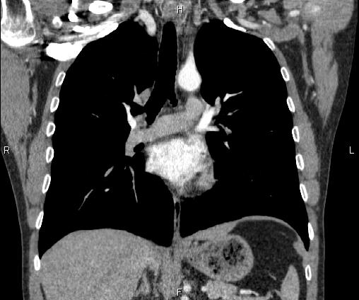 Bilateral pulmonary AVM (Radiopaedia 83134-97505 C 40).jpg