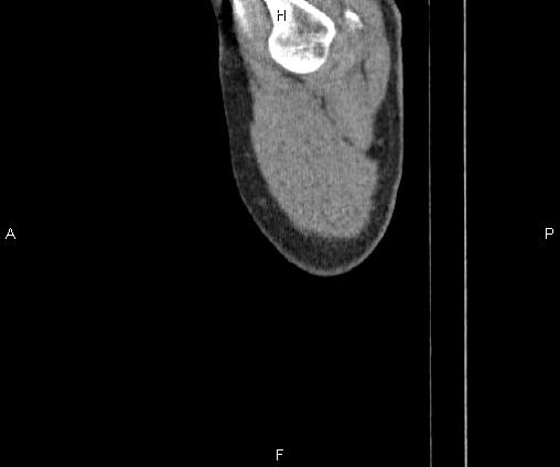 Bilateral pulmonary AVM (Radiopaedia 83134-97505 D 3).jpg