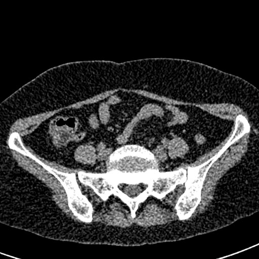 Bilateral staghorn calculi (Radiopaedia 59475-66842 Axial non-contrast 55).jpg