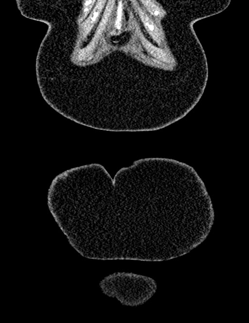 Bilateral staghorn calculi (Radiopaedia 59475-66842 Coronal non-contrast 28).jpg