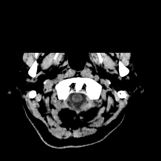 Bilateral subacute subdural hematoma (Radiopaedia 69240-79018 Axial non-contrast 2).jpg