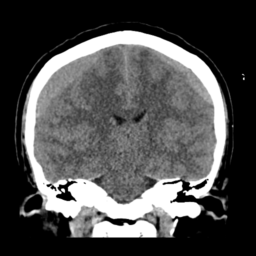 Bilateral subacute subdural hematoma (Radiopaedia 69240-79018 Coronal non-contrast 32).jpg