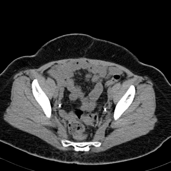 Bilateral ureteric stents (Radiopaedia 48795-53825 Axial non-contrast 55).jpg