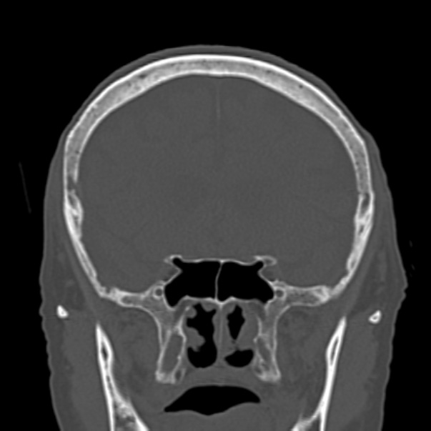 Biparietal osteodystrophy (Radiopaedia 46109-50463 Coronal bone window 41).jpg