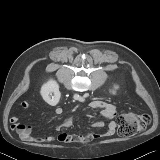 File:Bladder papillary urothelial carcinoma (Radiopaedia 48119-52951 Axial C+ delayed 26).png