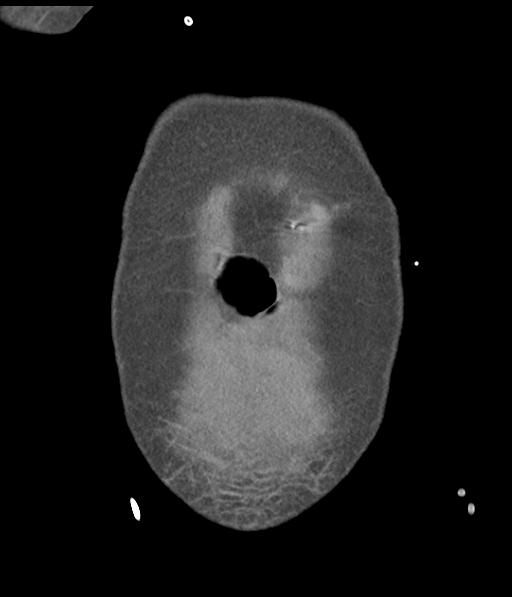 Bladder rupture post renal biopsy (Radiopaedia 30863-31572 Coronal non-contrast 8).jpg