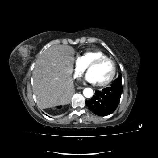 File:Bladder tumor detected on trauma CT (Radiopaedia 51809-57609 A 66).jpg