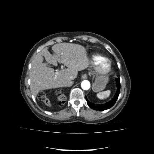File:Bladder tumor detected on trauma CT (Radiopaedia 51809-57609 A 79).jpg