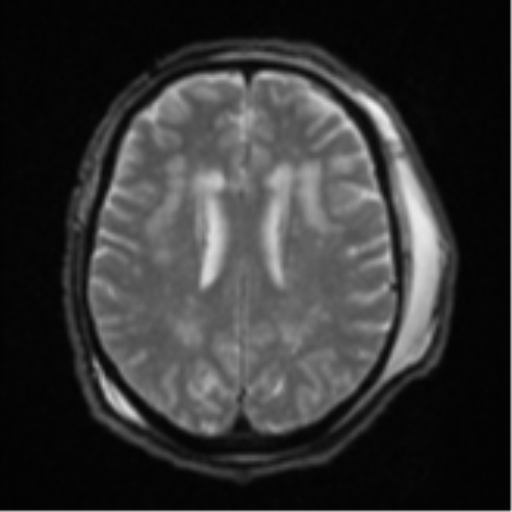 Blunt cerebrovascular injury (Radiopaedia 53682-59745 Axial DWI 20).png