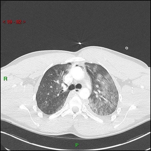File:Blunt thoracic trauma (Radiopaedia 73454-84221 Axial lung window 33).jpg
