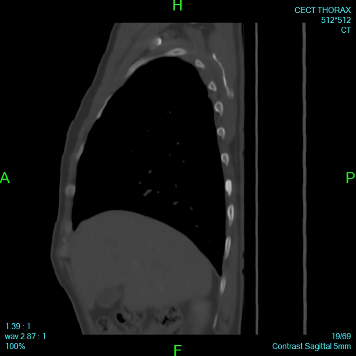 Bone metastases from lung carcinoma (Radiopaedia 54703-60937 Sagittal bone window 19).jpg