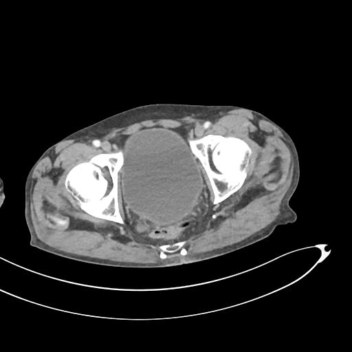 Bone metastasis from squamous cell carcinoma (Radiopaedia 30133-30730 B 73).jpg