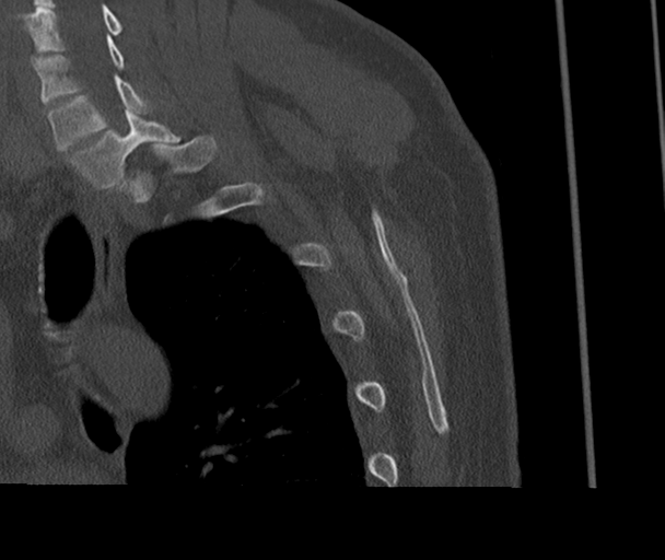 Bony Bankart and Hill-Sachs lesions (Radiopaedia 33622-34727 Sagittal bone window 72).png