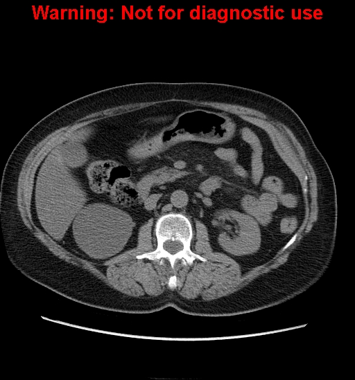 File:Bosniak renal cyst - type II (Radiopaedia 23404-23468 Axial non-contrast 15).jpg