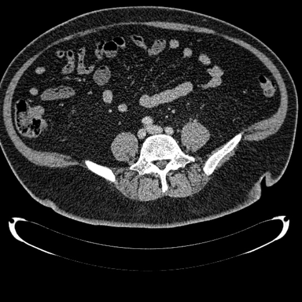 Bosniak renal cyst - type IV (Radiopaedia 24244-24518 C 257).jpg