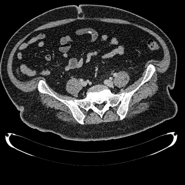 Bosniak renal cyst - type IV (Radiopaedia 24244-24518 C 287).jpg