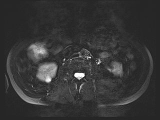 File:Bouveret syndrome (Radiopaedia 61017-68856 Axial MRCP 44).jpg