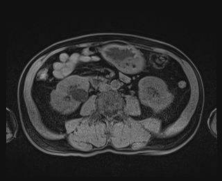 Bouveret syndrome (Radiopaedia 61017-68856 Axial T1 fat sat 53).jpg