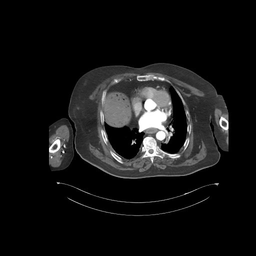 File:Bowel ischemia secondary to SMA occlusion with extensive portomesenteric venous gas (Radiopaedia 54656-60871 A 77).jpg