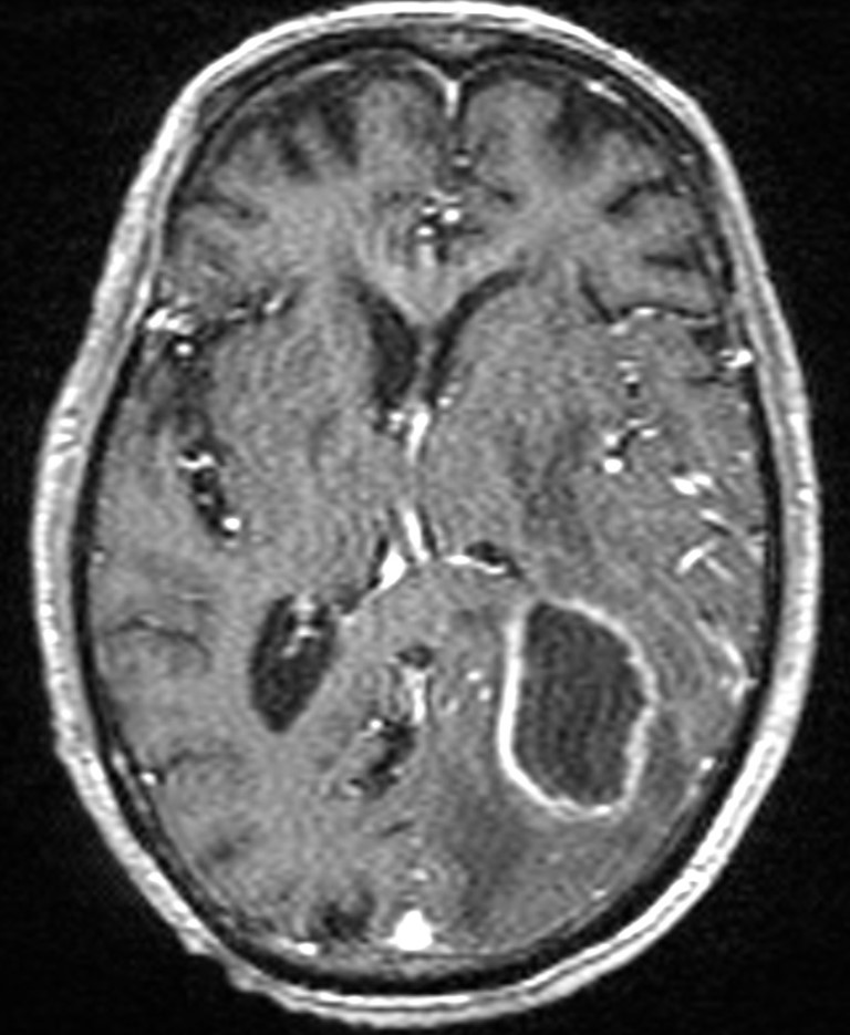 Brain abscess with dual rim sign (Radiopaedia 87566-103938 Axial T1 C+ 88).jpg