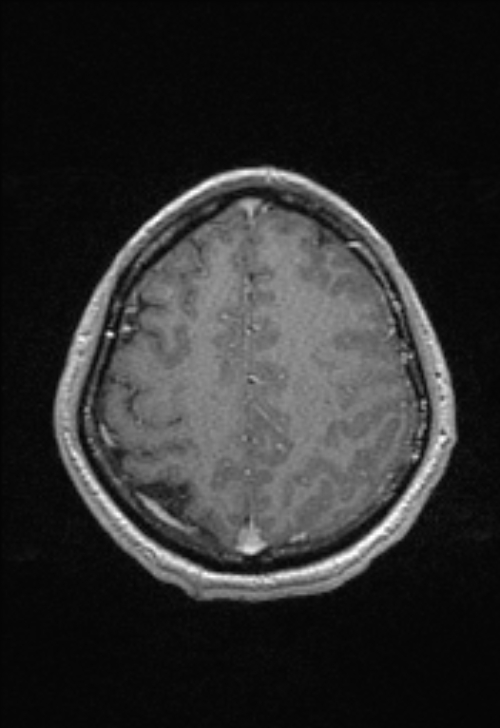 Brain abscess with ventriculitis (Radiopaedia 85703-101495 Axial T1 C+ 136).jpg