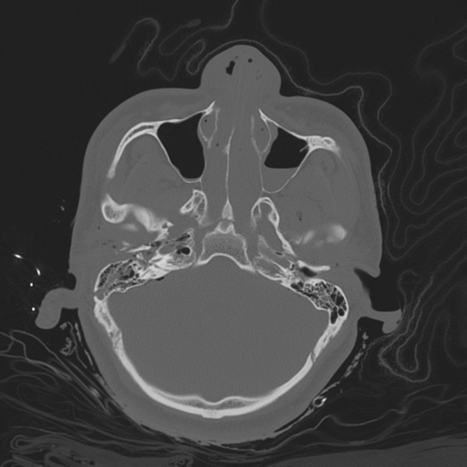 Brain contusions, internal carotid artery dissection and base of skull fracture (Radiopaedia 34089-35339 Axial bone window 52).png