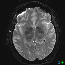 File:Brain death on MRI and CT angiography (Radiopaedia 42560-45689 Axial ADC 16).jpg