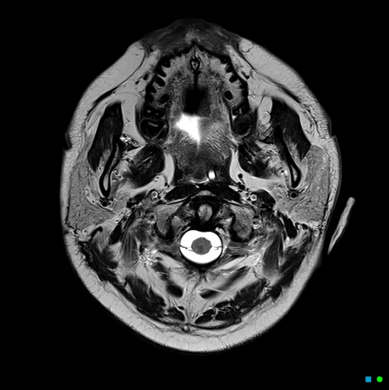 File:Brain death on MRI and CT angiography (Radiopaedia 42560-45689 Axial T2 1).jpg