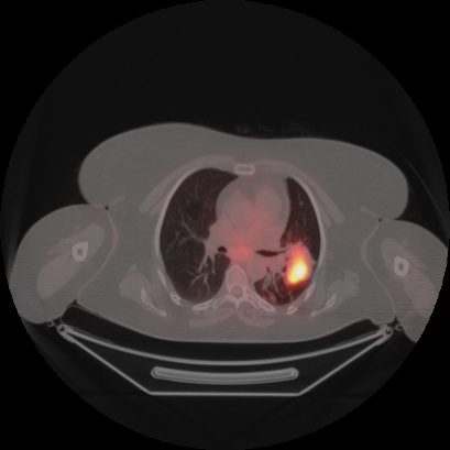 Brain metastasis (Radiopaedia 89847-106962 Axial lung window 25).jpg
