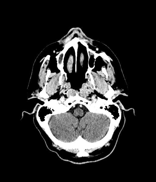 Brain metastasis (large cystic mass) (Radiopaedia 47497-52106 Axial C+ 14).png
