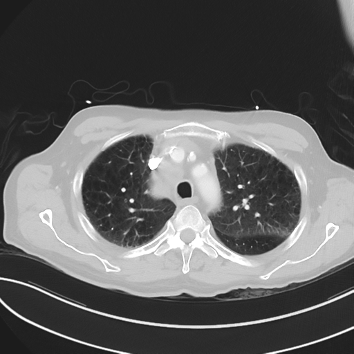 File:Brain metastasis (lung cancer) (Radiopaedia 48289-53180 Axial lung window 17).png
