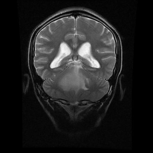 File:Brainstem glioma (Radiopaedia 30923-31624 Coronal T2 7).jpg