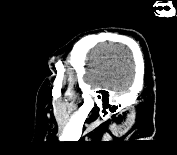 File:Brainstem hemorrhage (Radiopaedia 81294-94976 C 7).jpg