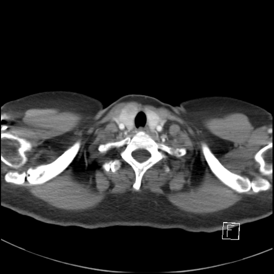 File:Breast metastases from renal cell cancer (Radiopaedia 79220-92225 A 4).jpg