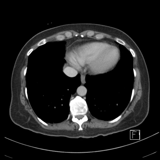 Breast metastases from renal cell cancer (Radiopaedia 79220-92225 C 4).jpg