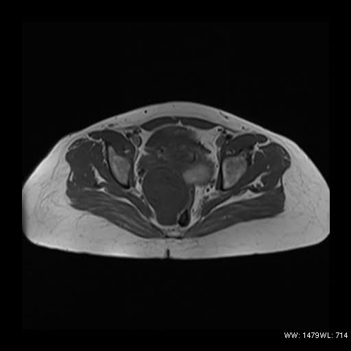 File:Broad ligament fibroid (Radiopaedia 49135-54241 Axial T1 11).jpg