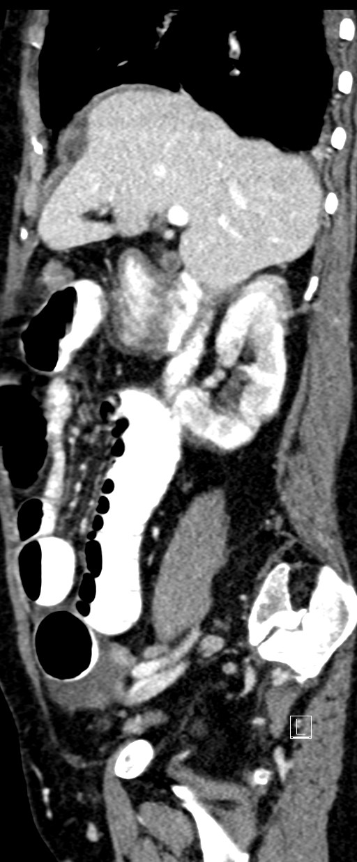 Broad ligament hernia (Radiopaedia 84802-100276 C 55).jpg
