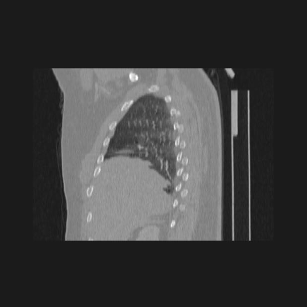 Bronchial atresia (Radiopaedia 60685-68439 Sagittal lung window 17).jpg