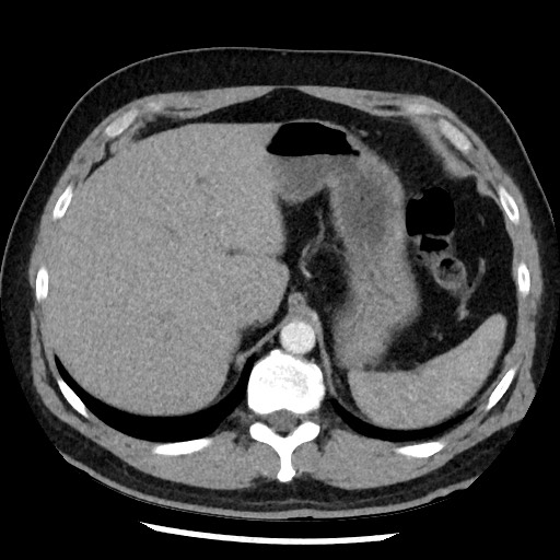 File:Bronchial carcinoid tumor (Radiopaedia 67377-76764 A 57).jpg