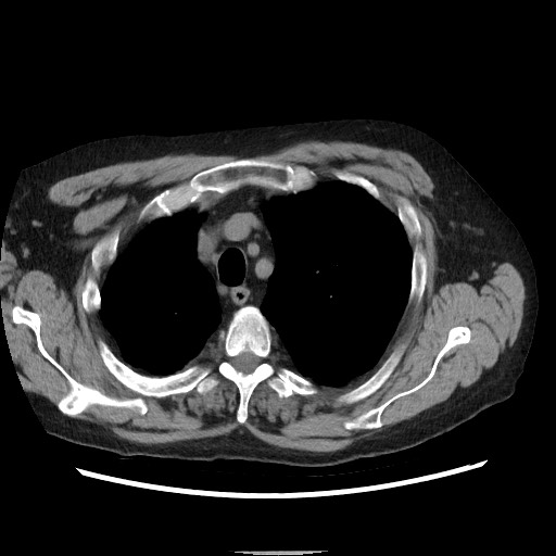 Bronchial stenosis - lung transplant (Radiopaedia 73133-83848 Axial non-contrast 14).jpg