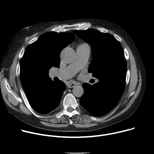 Bronchial stenosis - lung transplant (Radiopaedia 73133-83848 Axial non-contrast 32).jpg