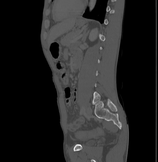 Bronchiectasis in Crohn disease (Radiopaedia 60311-67977 Sagittal bone window 164).jpg