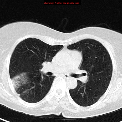 File:Bronchoalveolar carcinoma (BAC) (Radiopaedia 13436-13392 Axial lung window 24).jpg
