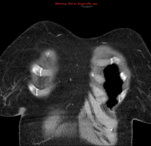 Bronchoalveolar carcinoma (BAC) (Radiopaedia 13436-13392 E 5).jpg