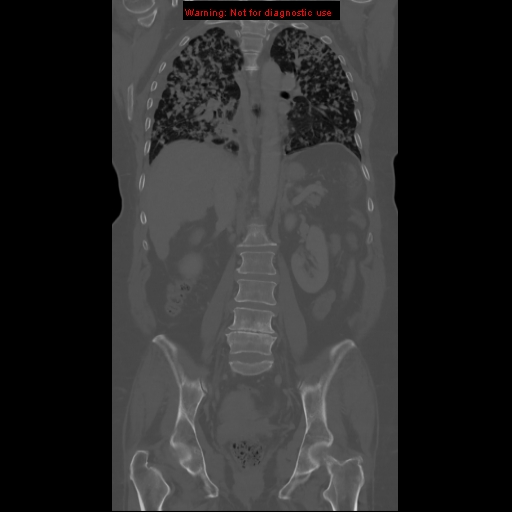 File:Bronchoalveolar carcinoma (Radiopaedia 13224-13233 Coronal non-contrast 15).jpg