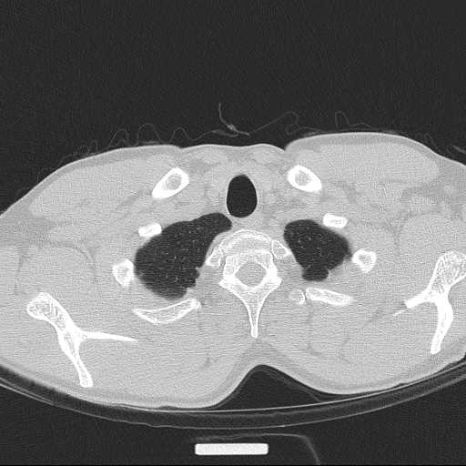 Bronchocele (Radiopaedia 60676-68429 Axial lung window 4).jpg