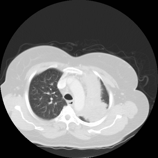 Bronchogenic carcinoma (Radiopaedia 73497-84262 Axial lung window 25).jpg